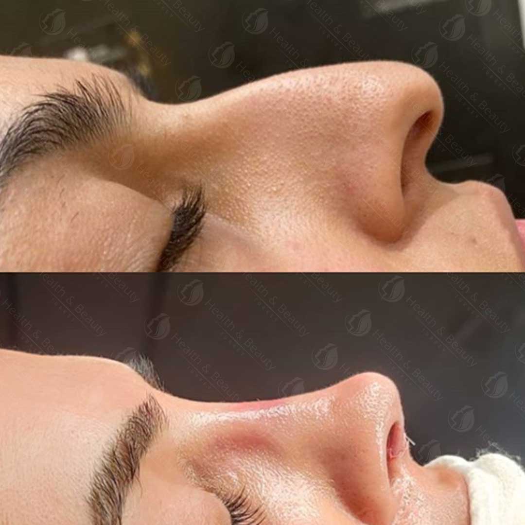 РИНОПЛАСТИКА